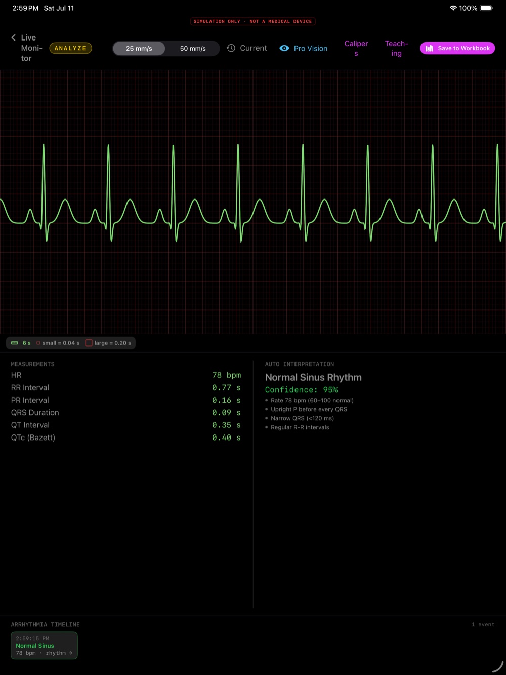 Analyze mode measuring a strip: heart rate, RR, PR, QRS, QT, and QTc intervals with an auto-interpretation of Normal Sinus Rhythm and its supporting reasons