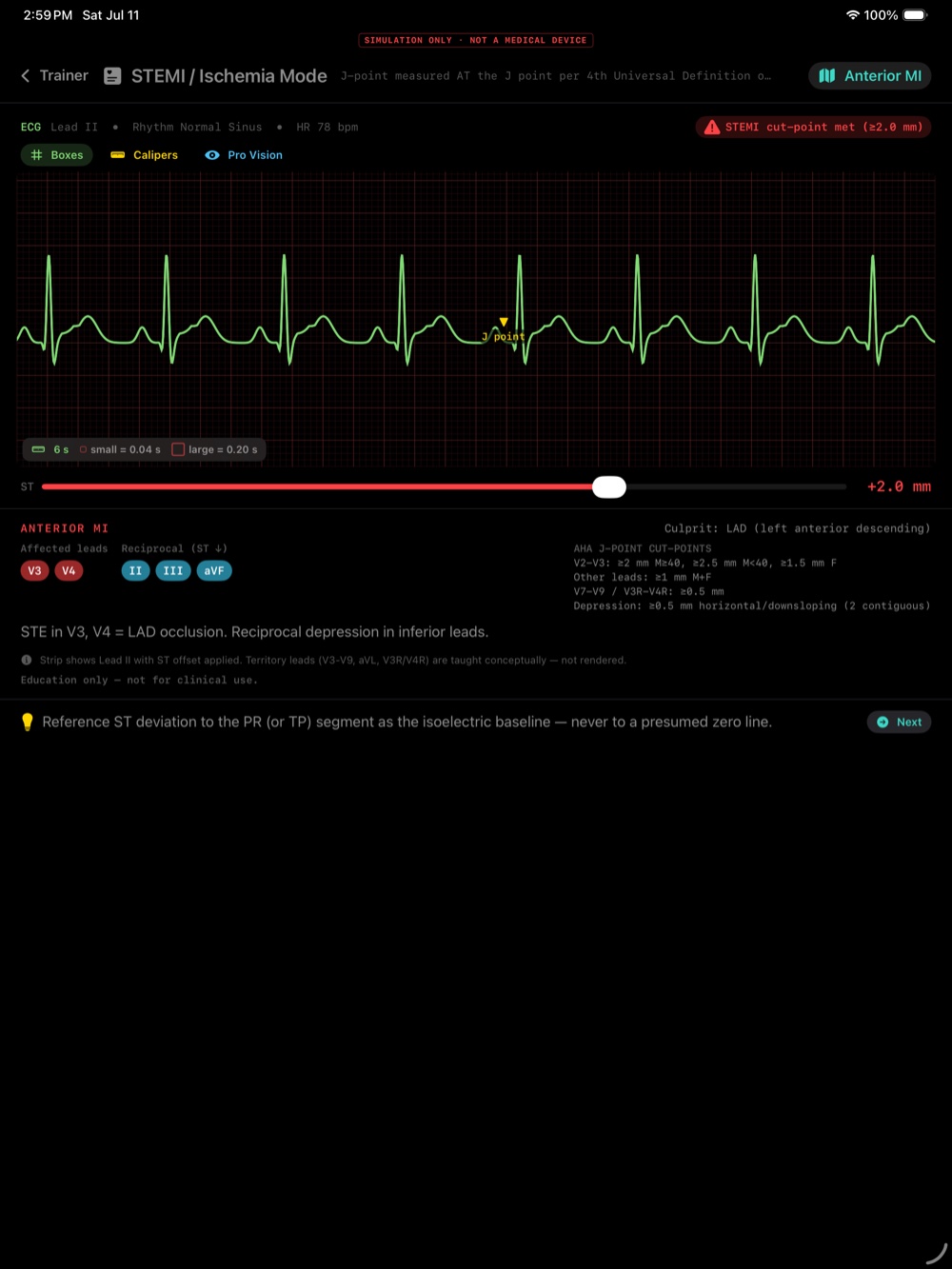 STEMI / Ischemia mode showing a J-point marker, an ST-elevation cut-point alert, affected and reciprocal leads, the culprit vessel, and AHA J-point cut-points